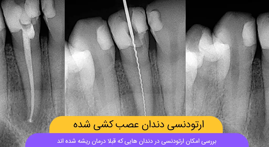 ارتودنسی دندان عصب کشی شده شاخص