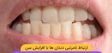 ارتباط نامرتبی دندان ها با افزایش شن شاخص