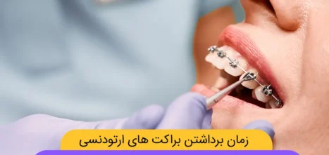 بهترین زمان برای برداشتن براکت های ارتودنسی شاخص