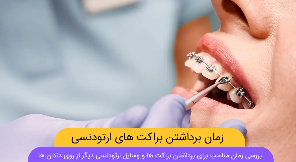 بهترین زمان برای برداشتن براکت های ارتودنسی شاخص