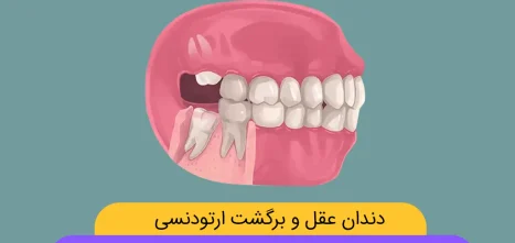 تاثیر دندان عقل بر برگشت ارتودنسی شاخص