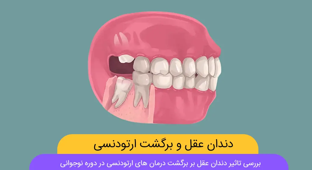 تاثیر دندان عقل بر برگشت ارتودنسی شاخص