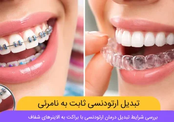 تبدیل ارتودنسی ثابت به نامرئی شاخص
