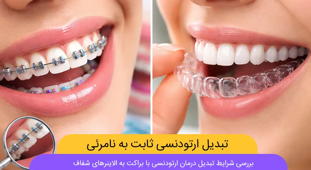تبدیل ارتودنسی ثابت به نامرئی شاخص
