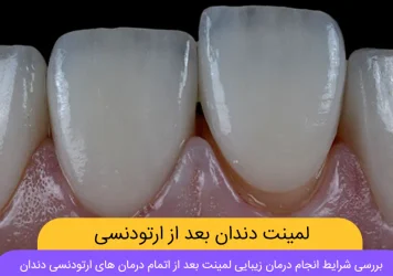 لمینت دندان بعد از ارتودنسی شاخص