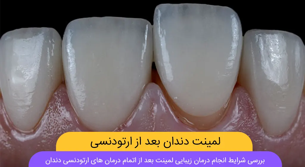 لمینت دندان بعد از ارتودنسی شاخص