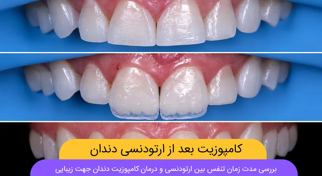 کامپوزیت بعد از ارتودنسی شاخص