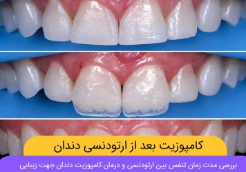 کامپوزیت بعد از ارتودنسی شاخص