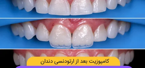 کامپوزیت بعد از ارتودنسی شاخص